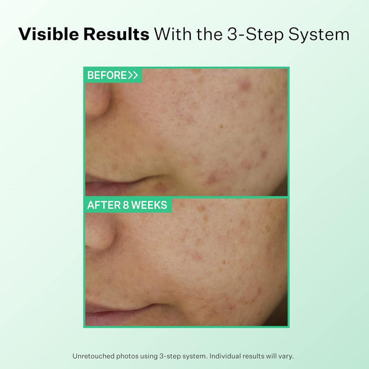 StriVectin 多效清洁温和日常清洁洁面乳,适合痤疮和痘痘肌肤,令肌肤更洁净、光滑、明亮,减少痘痘和粉刺,令肌肤更健康