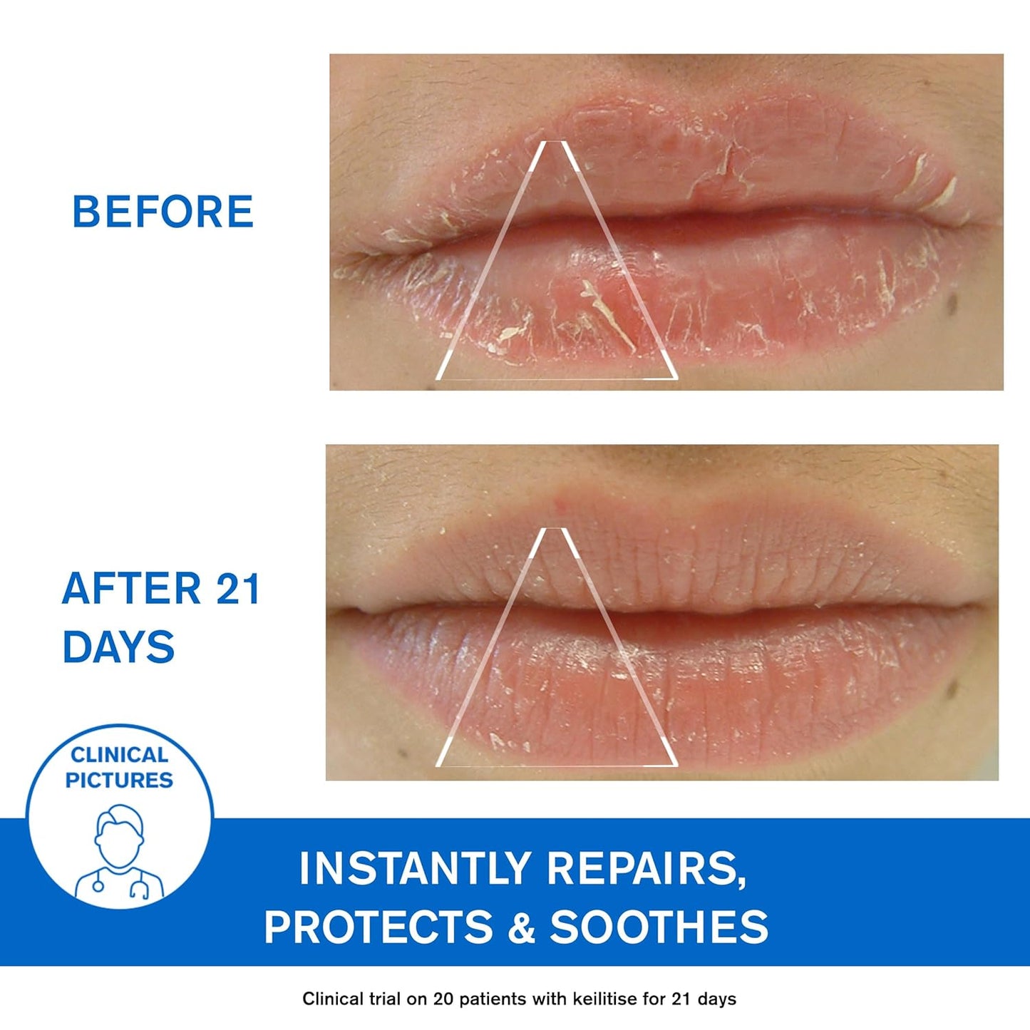 Uriage Bariéderm-CICA Lips Repairing Balm - Repairs, Insulates and Immediately Soothes Dry Chapped & Damaged Lips - With Glycerin - Long-Lasting Formula & Fragrance-Free - 15ml