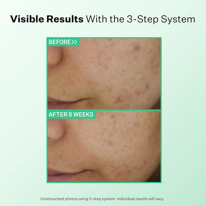 StriVectin 多效清洁温和日常清洁洁面乳，适合痤疮和痘痘肌肤，令肌肤更洁净、光滑、明亮，减少痘痘和粉刺，令肌肤更健康