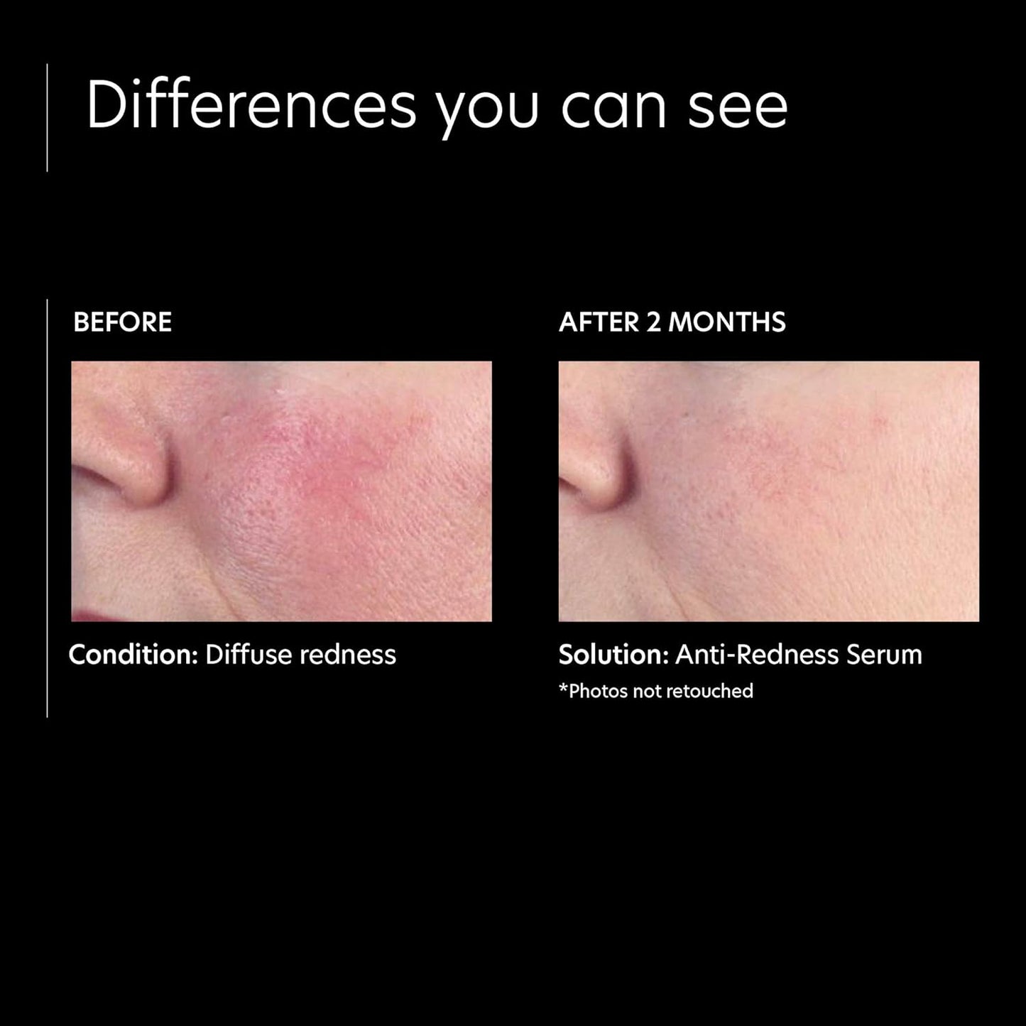 PCA SKIN Anti Redness Remover Face Serum, Oil Free (1 fl oz)