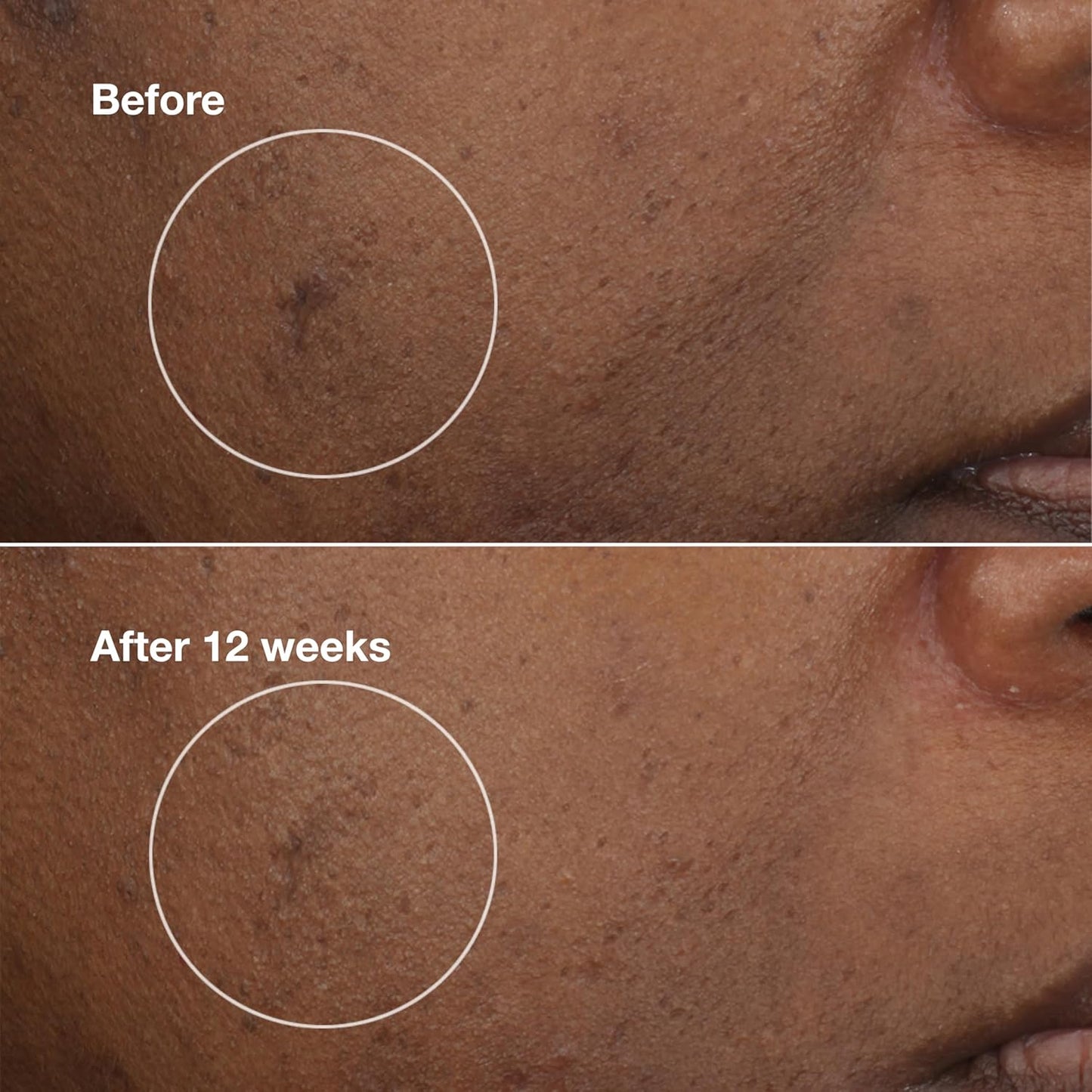 Clinique Even Better Clinical Brightening Moisturizer With Salicylic Acid, Glucosamine + Vitamin C | Hydrating + Dark Spot Reducing